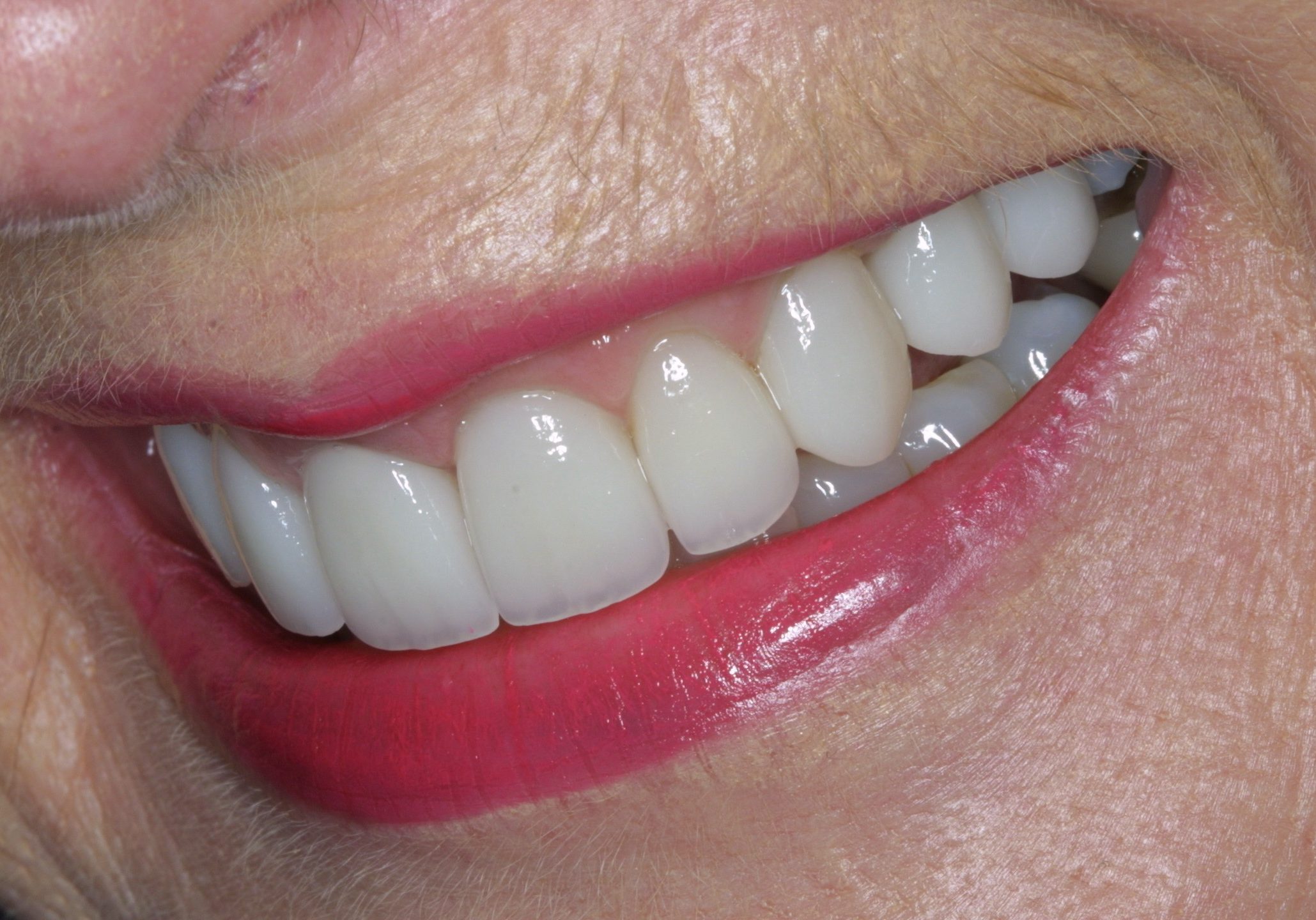 Close-up of a smile showing bright white teeth, likely dental veneers, with pink lips and surrounding skin texture visible.