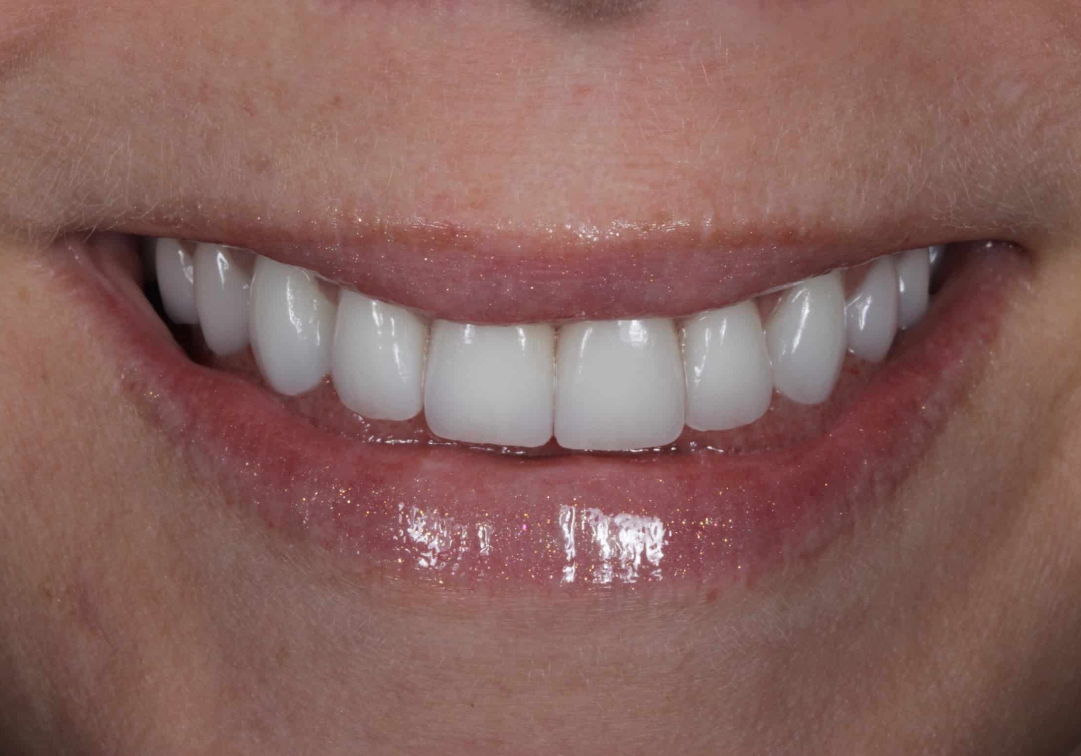 Close-up of a smile showing bright white dental veneers on the upper teeth and pink lips below the nose.