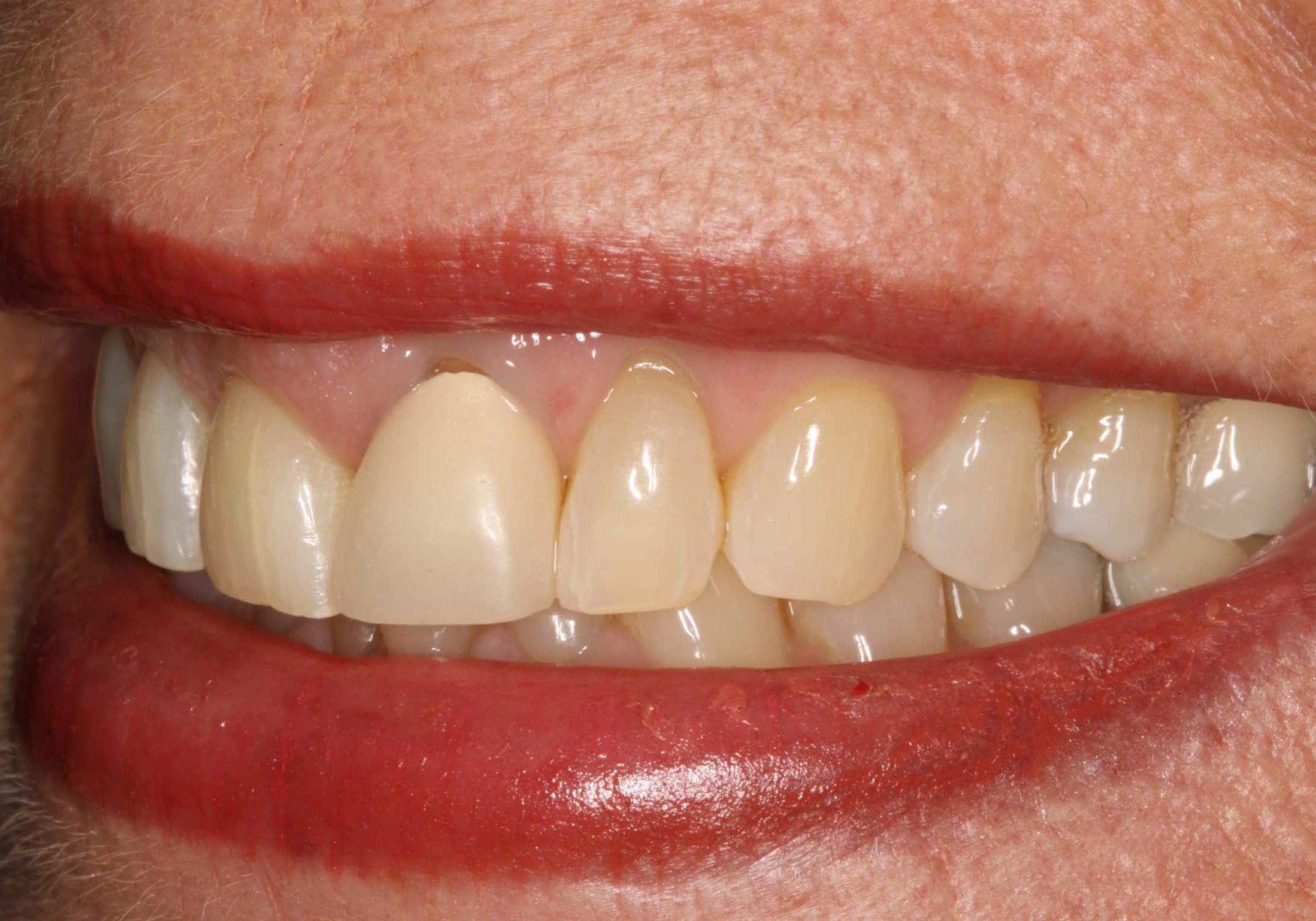 Close-up of a mouth with dark red lipstick, showing the upper lip and visible front teeth in a partial smile, lower face visible.