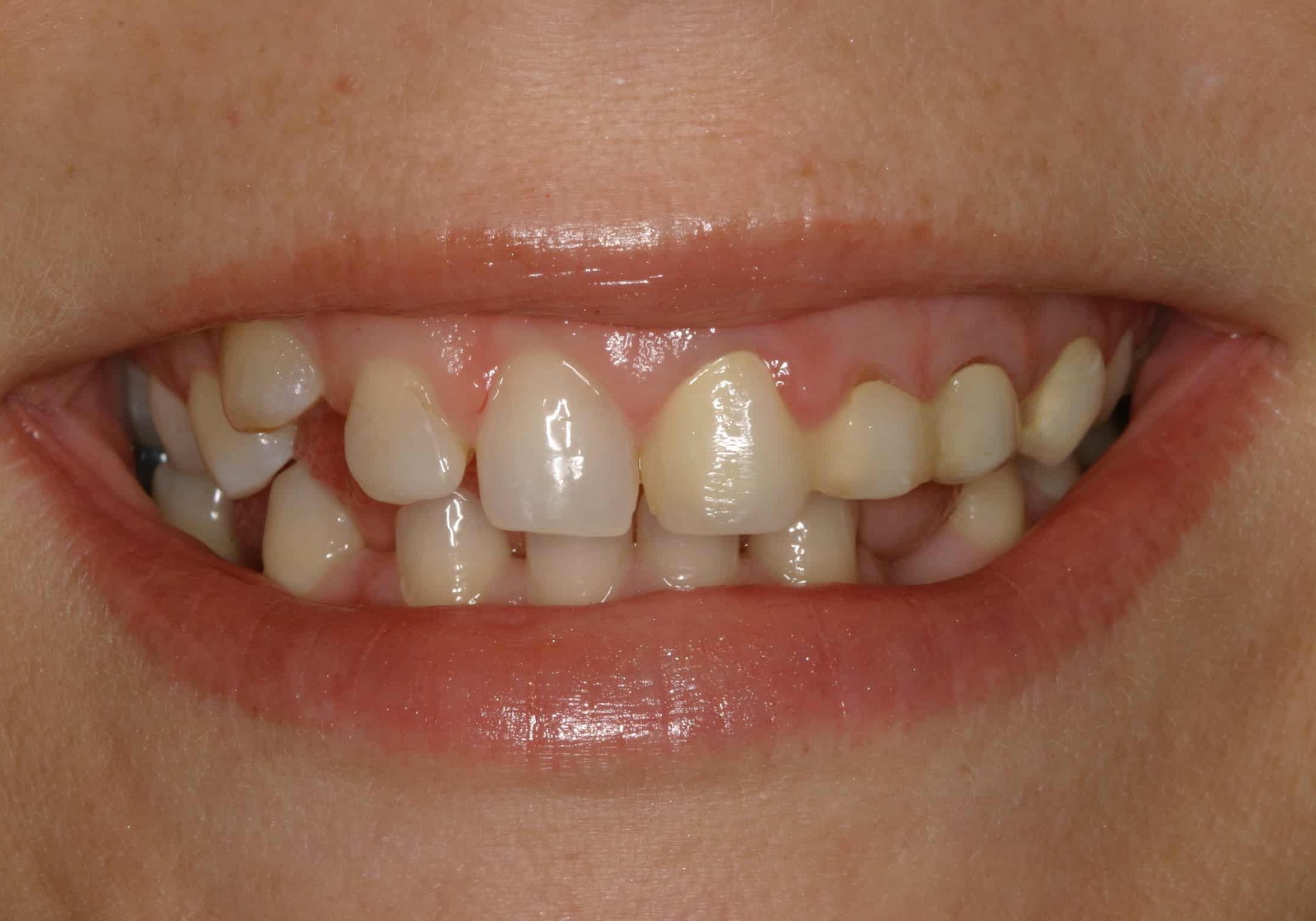Close-up of a mouth in a smile showing upper and lower teeth and gums, with mild crowding on the left side of the image.