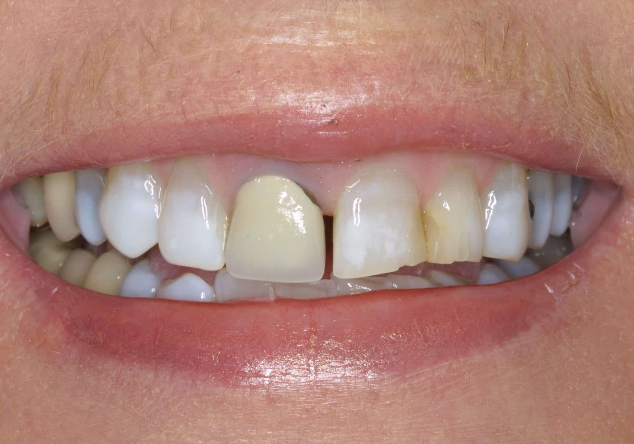 Close-up of a mouth with several upper front teeth, a large gap, and yellowed crowns; gums appear pink and slightly irritated.